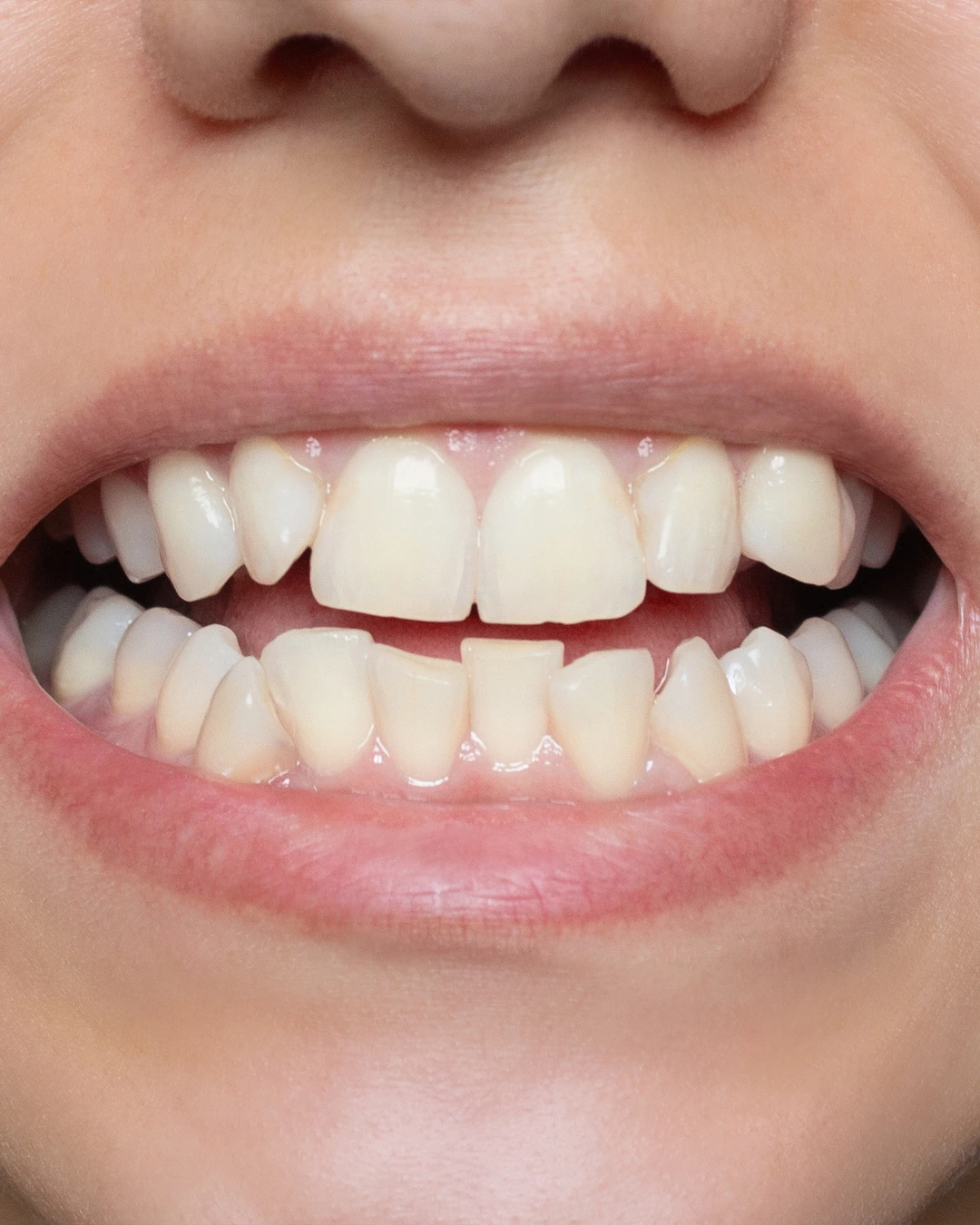 Teeth before whitening